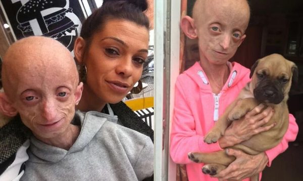 Tenía la enfermedad de Benjamin Button y murió a los 18 años