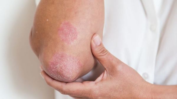 Cambios en las condiciones atmosféricas tienen efecto en la psoriasis - Estilo de vida - ABC Color