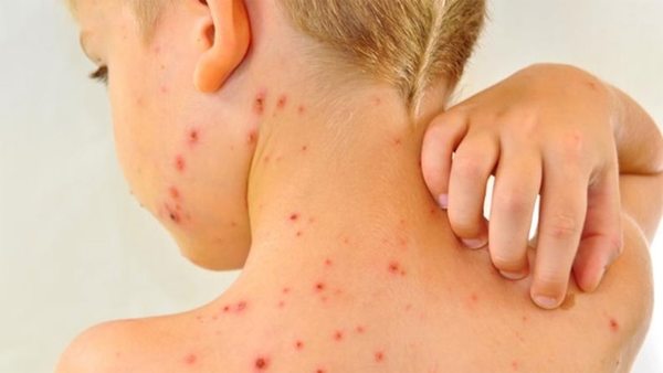 Por desidia paterna: peligro de rebrote de sarampión, polio y cáncer cervical - ADN Digital