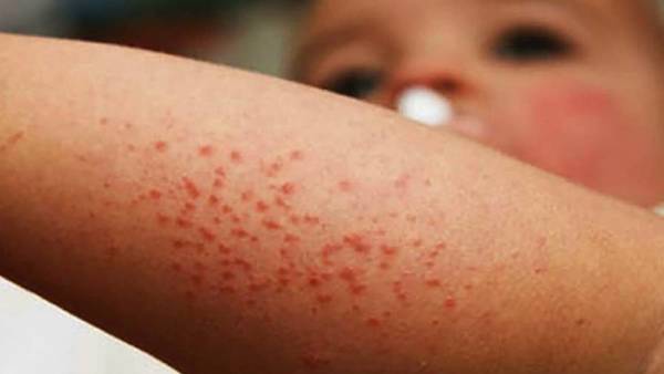 El sarampión mortal asoma y amenaza a niños porque muchos ya no les llevan para vacunarse