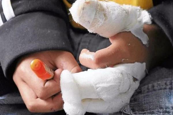 Caaguazú; Niño de 4 años sufrió graves lesiones tras explotar un cebollón en la mano – Prensa 5