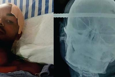 ¡Un milagro! Sobrevivió luego que una barra de hierro le cayó encima y atravesó su cabeza