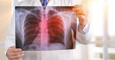 Detectado a tiempo, la tuberculosis se cura