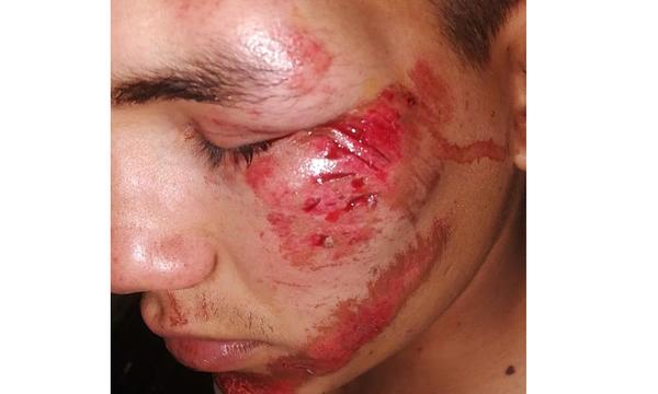 Joven sufrió lesiones tras accidente de tránsito en Coronel Oviedo – Prensa 5