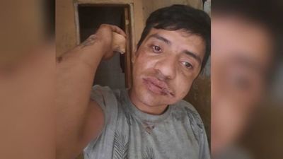 Lo confundieron con un ladrón y le reventaron la mandíbula
