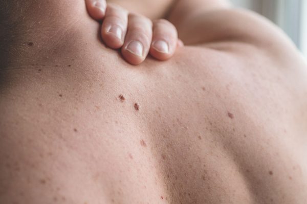 Cáncer de piel, una enfermedad en aumento | El Independiente