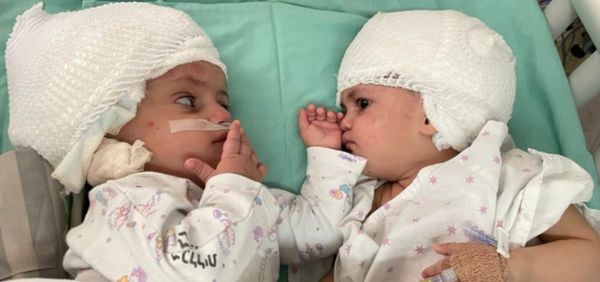 En Israel, lograron separar a siamesas unidas por la cabeza