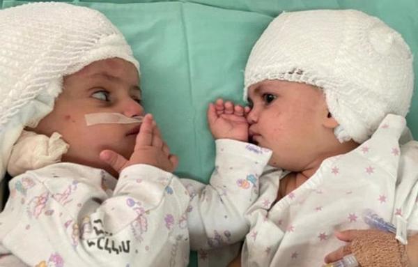 Con éxito, separan a siamesas unidas por la cabeza en Israel