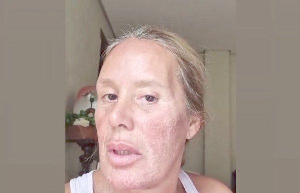 Crónica / Exmodelo apareció con la cara quemada y asustó al rollo ¡Ndi!