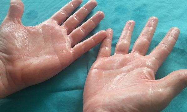 Hiperhidrosis: Sudar en extremo | Telefuturo