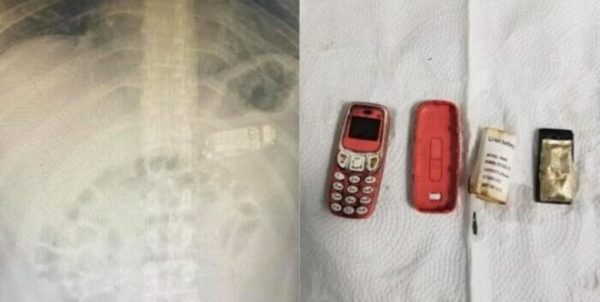 Cirujanos extraen un teléfono Nokia del estómago de un preso en Kosovo