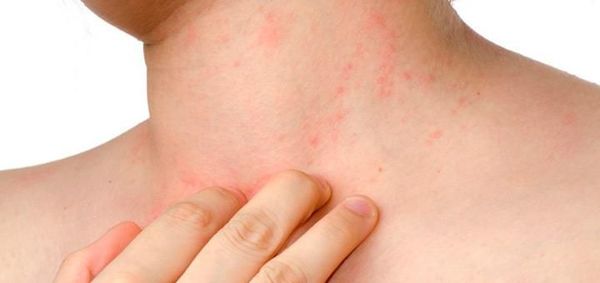 Picazón constante: Sepa más sobre la dermatitis atópica - Estilo de vida - ABC Color