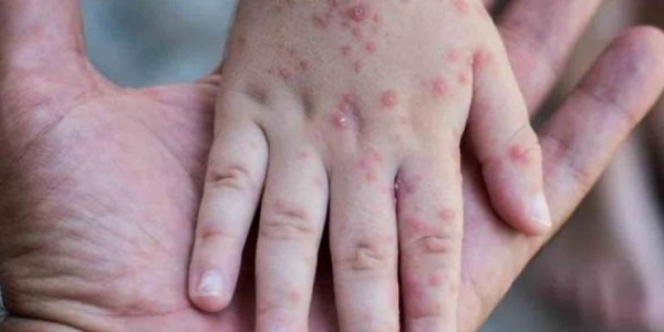 Diario HOY | Instan a padres vacunar a sus hijos ante posible rebrote de sarampión