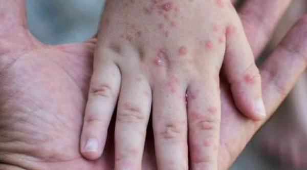 Instan a padres a vacunar a sus hijos ante posible rebrote de sarampión – Prensa 5