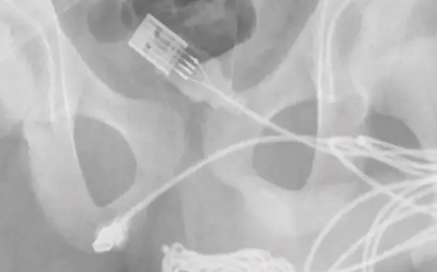Adolescente casi murió tras meter un cable de cargador en el "amigo"
