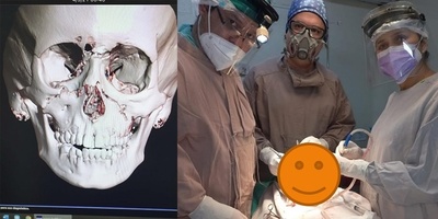 HRE: RECONSTRUCCIÓN FACIAL A NIÑO DE 9 AÑOS CON PLACAS Y TORNILLOS REABSORBIBLES