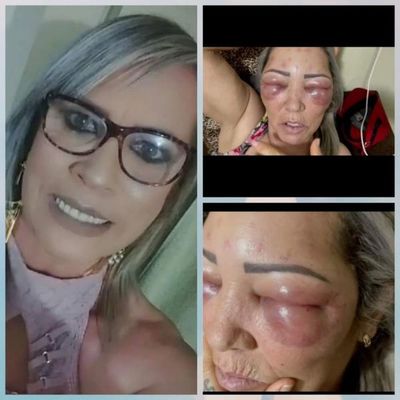 Mujer quedó con el rostro desfigurado tras procedimiento estético