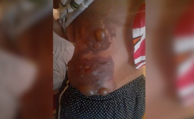 Derramó caliente a su vecina y la dejó con 30% del cuerpo quemado