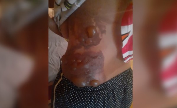 Derramó caliente a su vecina y la dejó con 30% del cuerpo quemado