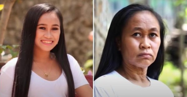 La impactante historia de una adolescente que sufre progeria: “Tengo 16 años, pero aparento 50” - SNT