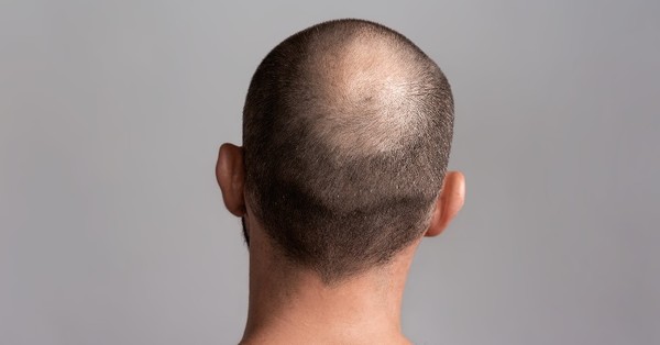 Descubren un mecanismo genético que podría detener la caída del cabello - SNT