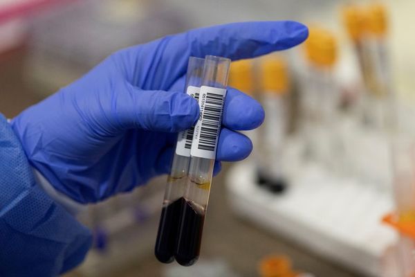 Identifican en sangre señales de advertencia de la demencia - Ciencia - ABC Color