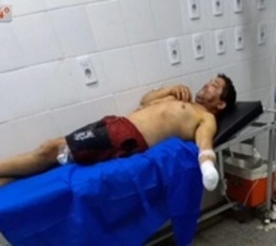 Amputan la mano a un hombre durante pelea en Areguá - Paraguay.com