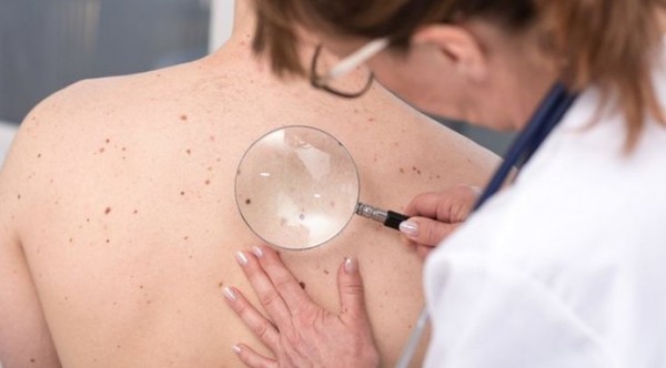 Lanzarán campaña de prevención de cáncer de piel con evaluaciones a pacientes