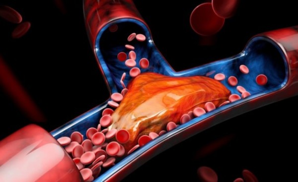 Día Mundial de la Trombosis: esta enfermedad se puede prevenir