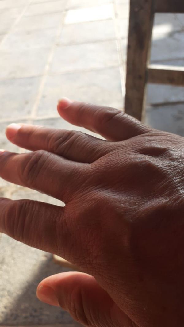 Artritis reumatoidea, una enfermedad que requiere más “luz” - Estilo de vida - ABC Color