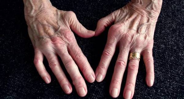Por el «Día Mundial de la Artritis Reumatoide» promueven una mejor calidad de vida - ADN Digital