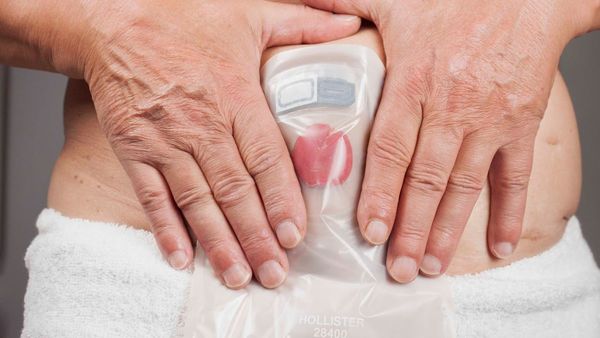 Salud se compromete con ostomizados a normalizar distribución de insumos