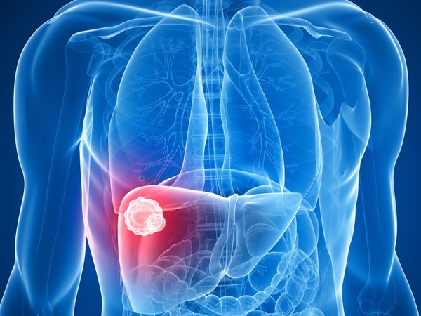 DESCUBREN EL PAPEL DEL COLESTEROL EN EL DESARROLLO DEL CARCINOMA HEPATOCELULAR - La Voz del Norte