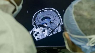 Un implante cerebral que elimina los pensamientos negativos para tratar la depresión genera controversia en la comunidad científica