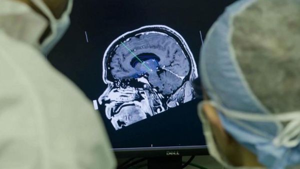 Un implante cerebral que elimina los pensamientos negativos para tratar la depresión genera controversia en la comunidad científica