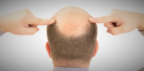 FELICES LOS ALOPECIOS CON EL DESCUBRIMIENTO CIENTÍFICO - La Voz del Norte