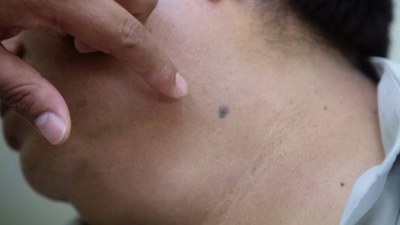 Diario HOY | Controlarán manchas y lunares a personas que posean riesgos de cáncer piel:
