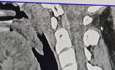 Diario HOY | Post Covid-19: primer paciente en recibir stent traqueal en el país