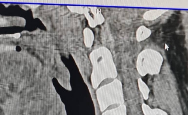 Diario HOY | Post Covid-19: primer paciente en recibir stent traqueal en el país