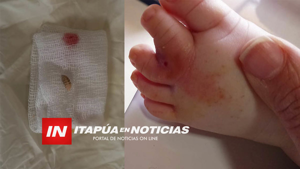 SACAN UNA “URA” DEL PIE DE UN BEBÉ DE NUEVE MESES EN PUESTO DE SALUD DE HOHENAU. - Itapúa Noticias