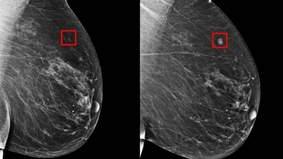 Diario HOY | Mamografía para detectar el cáncer de mama: técnica útil pero a veces sobrevalorada