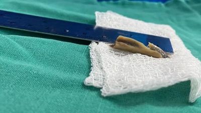 Le quitaron un enorme hueso de pollo de los pulmones
