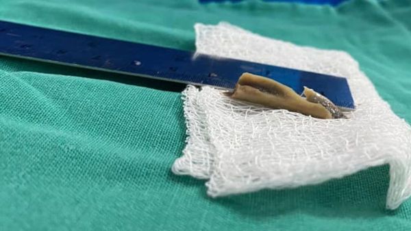 Le quitaron un enorme hueso de pollo de los pulmones