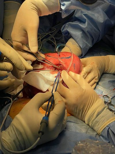 En IPS realizan exitosa sexta cirugía intrauterina a una gestante de 27 semanas - .::Agencia IP::.