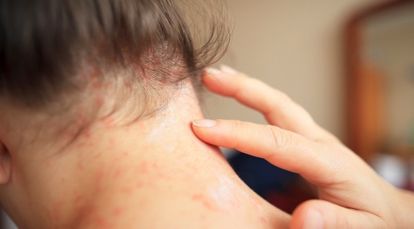 Especialistas inician los preparativos para recordar el Día Mundial de la Psoriasis