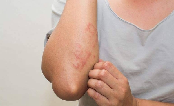 Diario HOY | Psoriasis puede controlarse siguiendo el tratamiento correcto