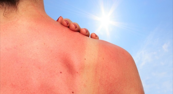 EVITE EXPONERSE A RAYOS DE SOL EN HORARIOS DE RIESGO - Itapúa Noticias