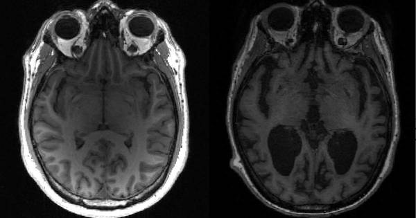 La Nación / Científicos descubren causas del avance del mal de Alzheimer en el cerebro