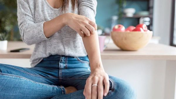 Psoriasis, una enfermedad incurable pero llevadera