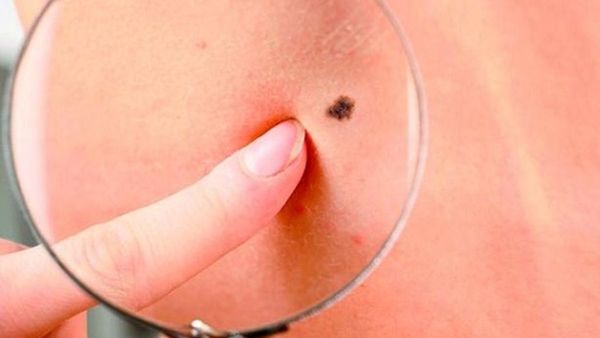 Detectaron probables tipos de cáncer de piel » San Lorenzo PY